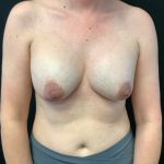 Breast Implant Removal w/ Lift Patient 03 Before Thumbnail Photo