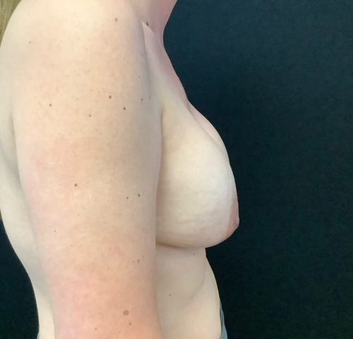 Breast Implant Removal w/ Lift Patient 03 Before Photo