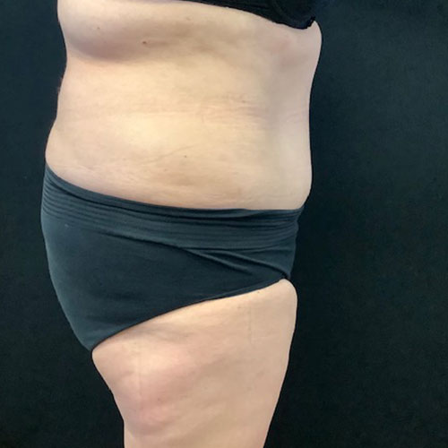 Abdominoplasty 16 After Photo