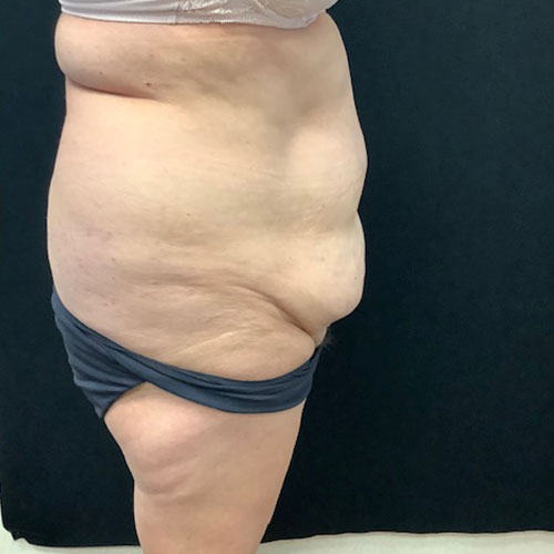 Abdominoplasty 16 Before Photo