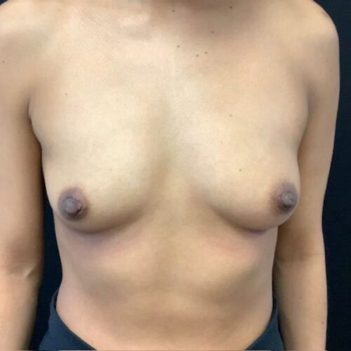 Breast Augmentation Patient 29 Before Photo