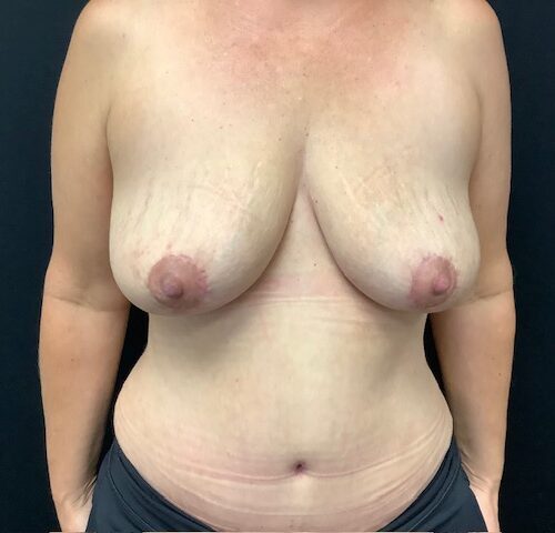 Breast Implant Removal w/ Lift Patient 04 After Photo