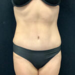 Abdominoplasty 17 After Thumbnail Photo