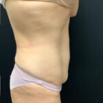 Abdominoplasty 17 Before Thumbnail Photo