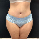 Abdominoplasty 18 After Thumbnail Photo