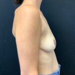 Breast Implant Removal w/ Lift Patient 05 After Thumbnail Photo