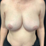 Breast Reduction 06 After Thumbnail Photo
