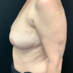 Breast Reduction 06 After Thumbnail Photo