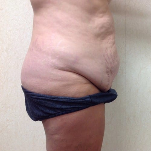 Abdominoplasty-01 | Before Abdominoplasty 1