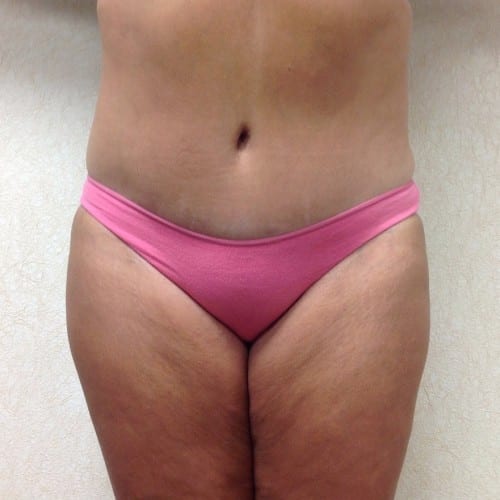 Abdominoplasty-01 | After Abdominoplasty 2