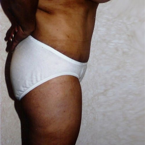 Abdominoplasty-02 | After Abdominoplasty 1