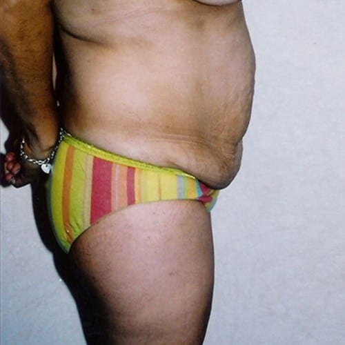 Abdominoplasty-02 | Before Abdominoplasty 1