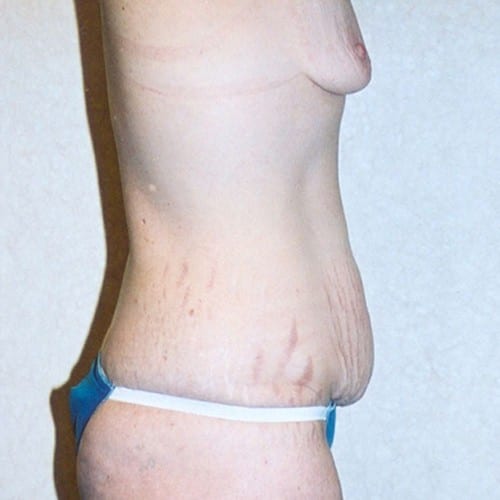 Abdominoplasty-03 | Before Abdominoplasty 1