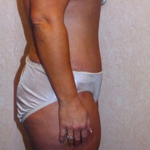 Abdominoplasty-04 | After Abdominoplasty 1