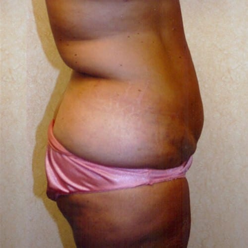 Abdominoplasty-04 | Before Abdominoplasty 1