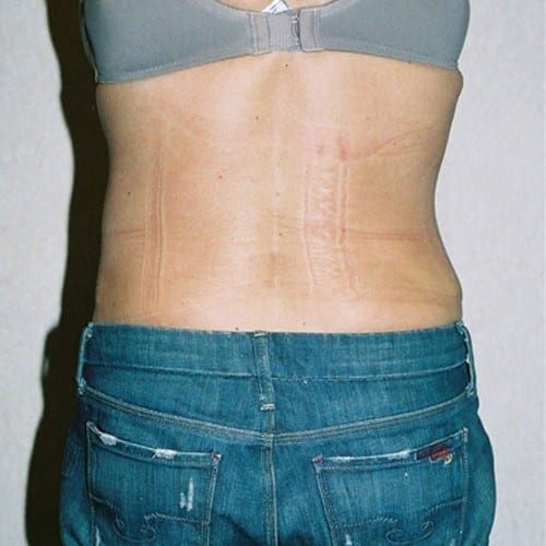 Abdominoplasty-05 | After Abdominoplasty 1