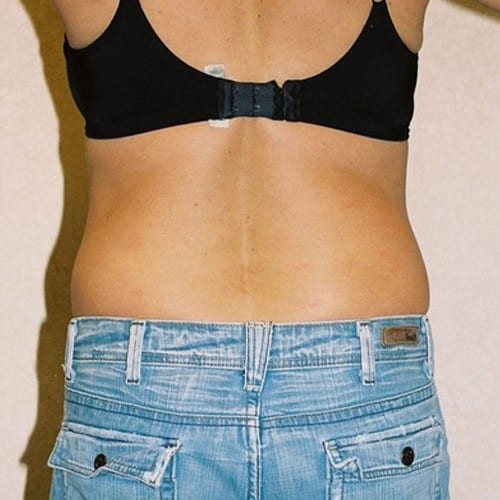 Abdominoplasty-05 | Before Abdominoplasty 1