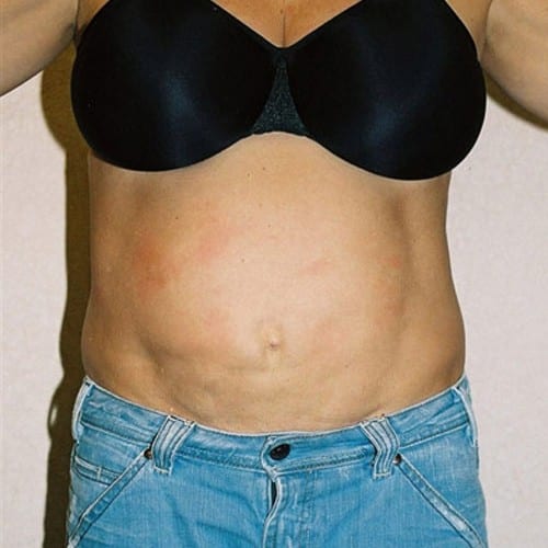 Abdominoplasty-05 | Before Abdominoplasty 2