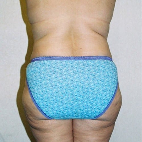 Abdominoplasty-06 | After Abdominoplasty 1
