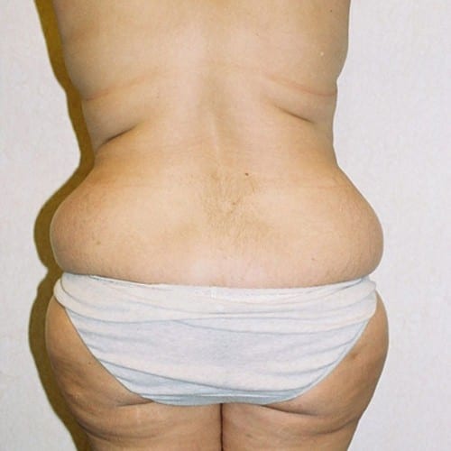 Abdominoplasty-06 | Before Abdominoplasty 1