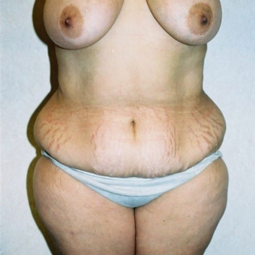 Abdominoplasty-06 | Before Abdominoplasty 2