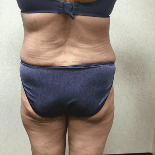 Abdominoplasty-07 | After Abdominoplasty 1