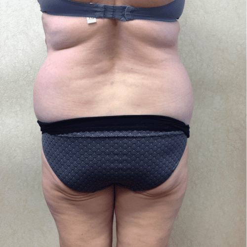 Abdominoplasty-07 | Before Abdominoplasty 1