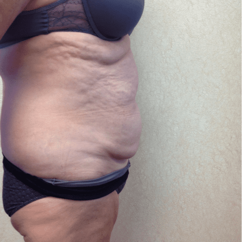 Abdominoplasty-07 | Before Abdominoplasty 3