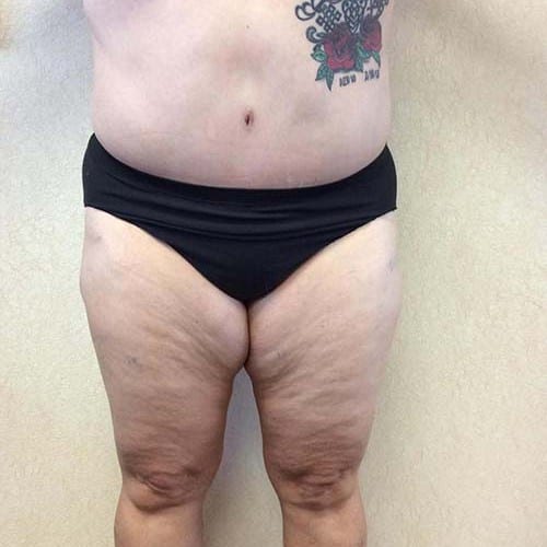 Abdominoplasty-08 | After Abdominoplasty 2