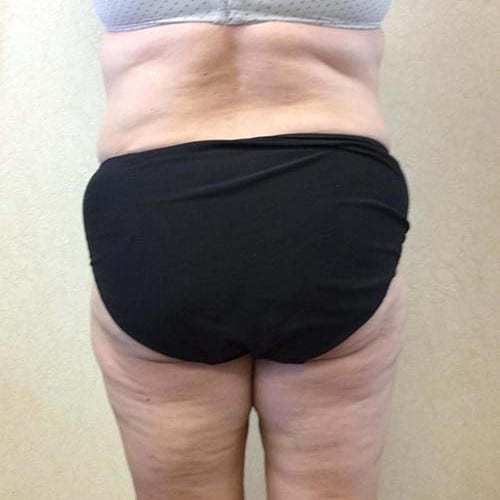 Abdominoplasty-08 | After Abdominoplasty 3