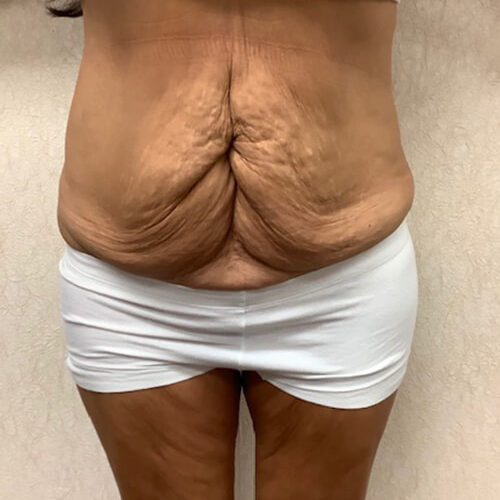 Abdominoplasty-09 | Before Abdominoplasty 2