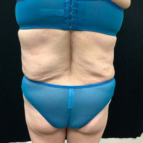 Abdominoplasty-10 | After Abdominoplasty 1