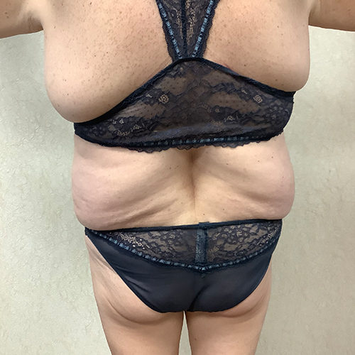 Abdominoplasty-10 | Before Abdominoplasty 1