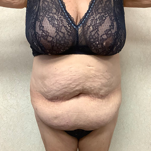 Abdominoplasty-10 | Before Abdominoplasty 2