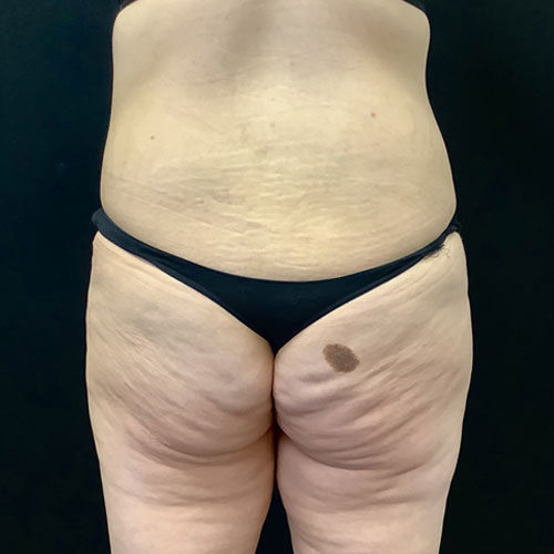 Abdominoplasty-11 | After Abdominoplasty 1