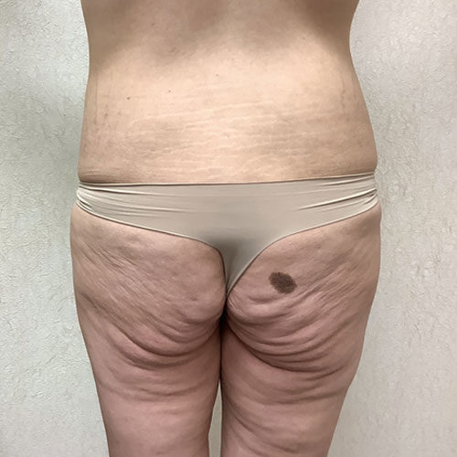 Abdominoplasty-11 | Before Abdominoplasty 1