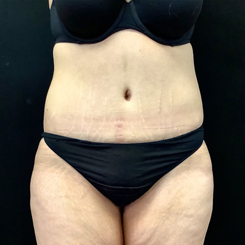 Abdominoplasty-11 | After Abdominoplasty 2