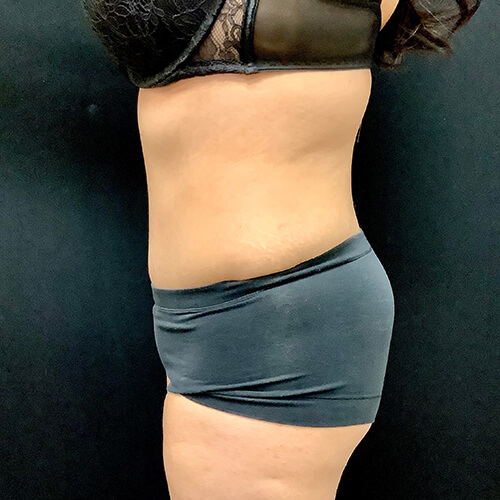 Abdominoplasty-13 | After Abdominoplasty 1