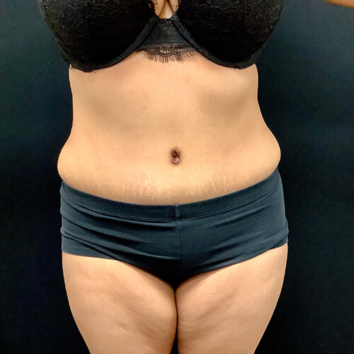 Abdominoplasty-13 | After Abdominoplasty 2