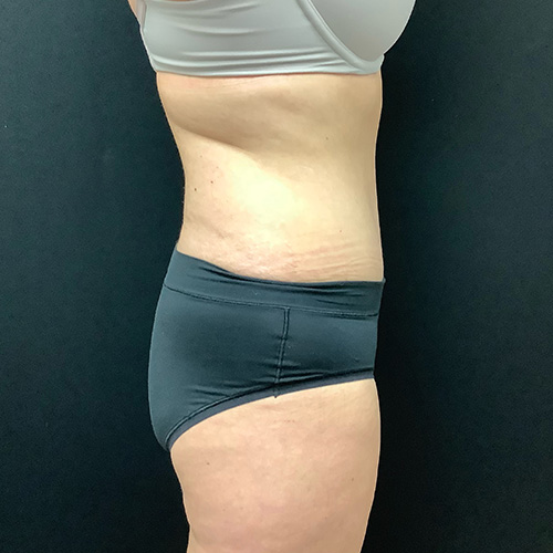 Abdominoplasty-14 | After Abdominoplasty 1