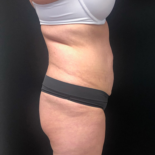 Abdominoplasty-14 | Before Abdominoplasty 1