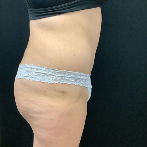 Abdominoplasty-15 | After Abdominoplasty