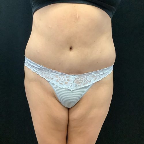 Abdominoplasty-15 | After Abdominoplasty 2