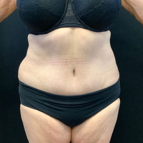 Abdominoplasty-16 | After Abdominoplasty 2