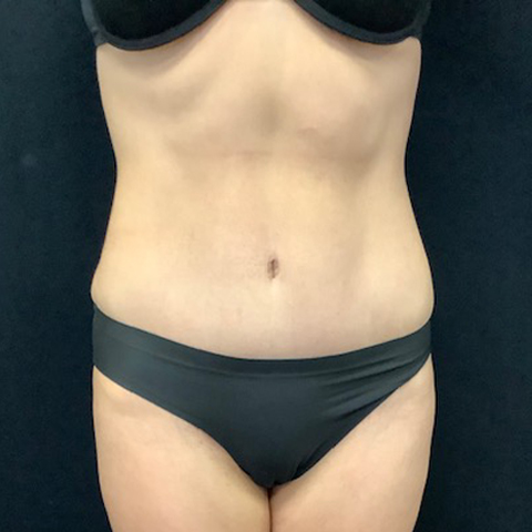 Abdominoplasty-17 | After Abdominoplasty 2