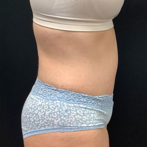 post op abdominoplasty tummy tuck surgery