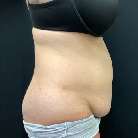 pre op abdominoplasty tummy tuck surgery