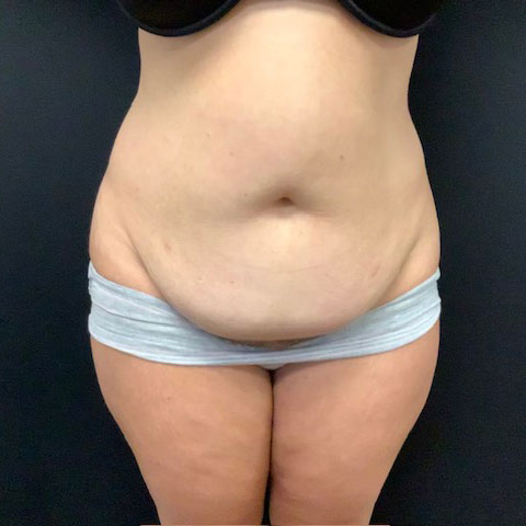 abdominoplasty 18 before