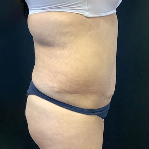 post op abdominoplasty tummy tuck surgery