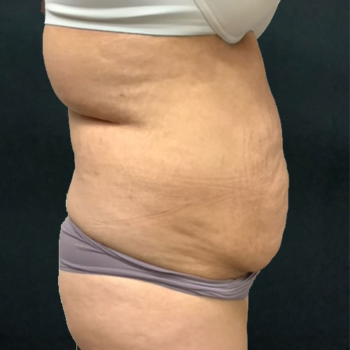 pre op abdominoplasty tummy tuck surgery